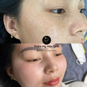 Điều trị tàn nhang