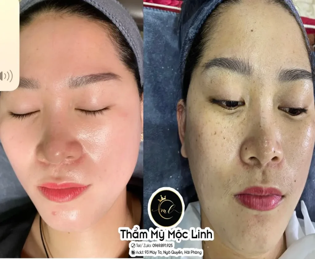 Trị nám/tàn nhang uy tín tại Hải Phòng