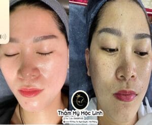 Điều trị tàn nhang
