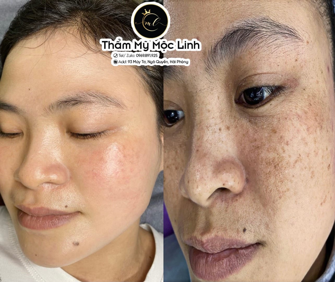 Kết quả điều trị nám da cho khách hàng tại Thẩm Mỹ Mộc Linh Hải Phòng