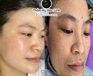 Điều trị tàn nhang