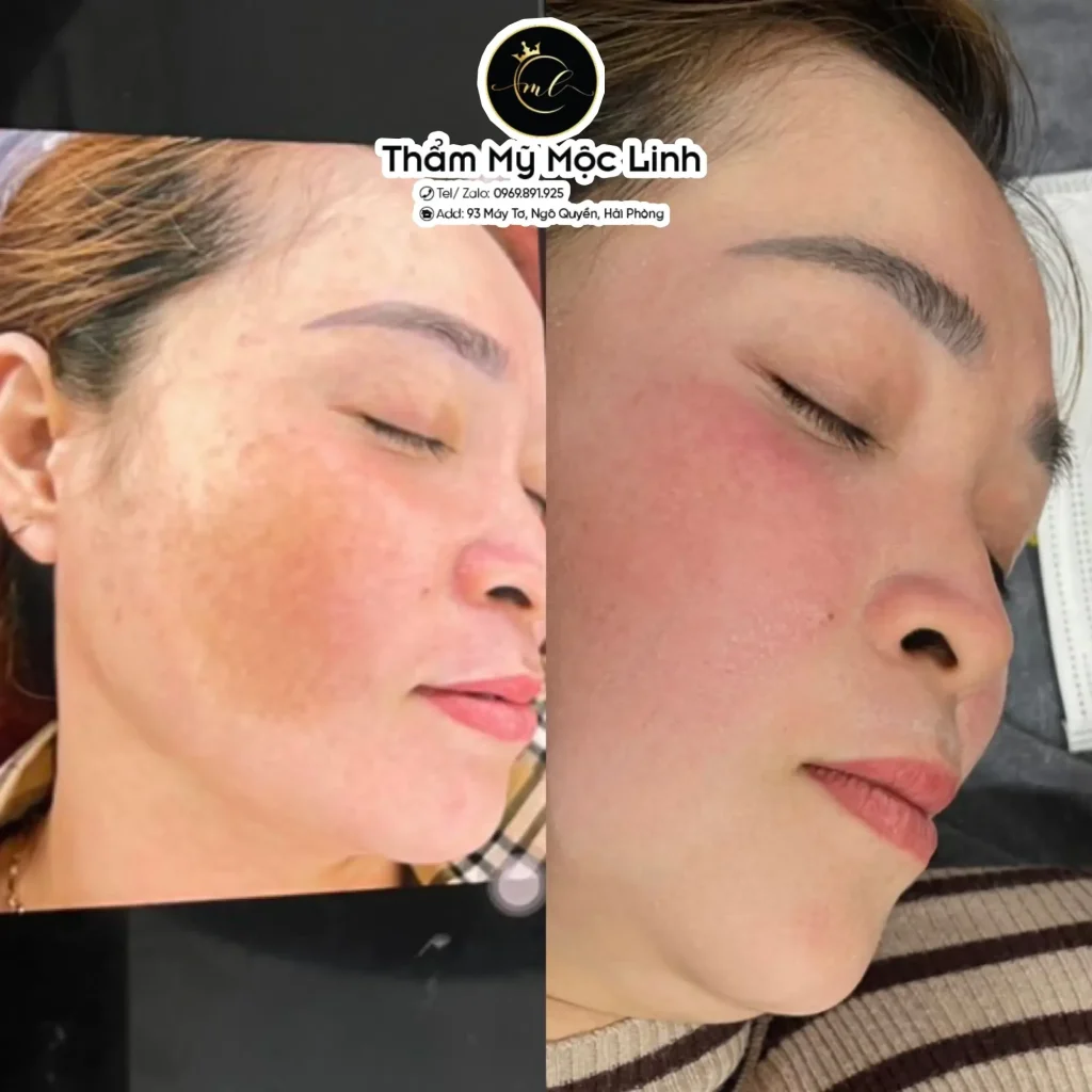 Trị nám/tàn nhang uy tín tại Hải Phòng