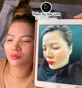 Trị nám/tàn nhang uy tín tại Hải Phòng