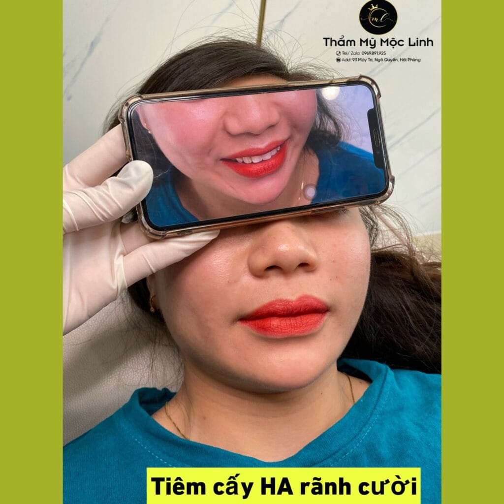 Tiêm môi