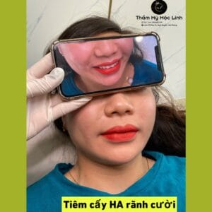 Tiêm môi