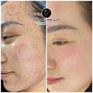 Điều trị tàn nhang