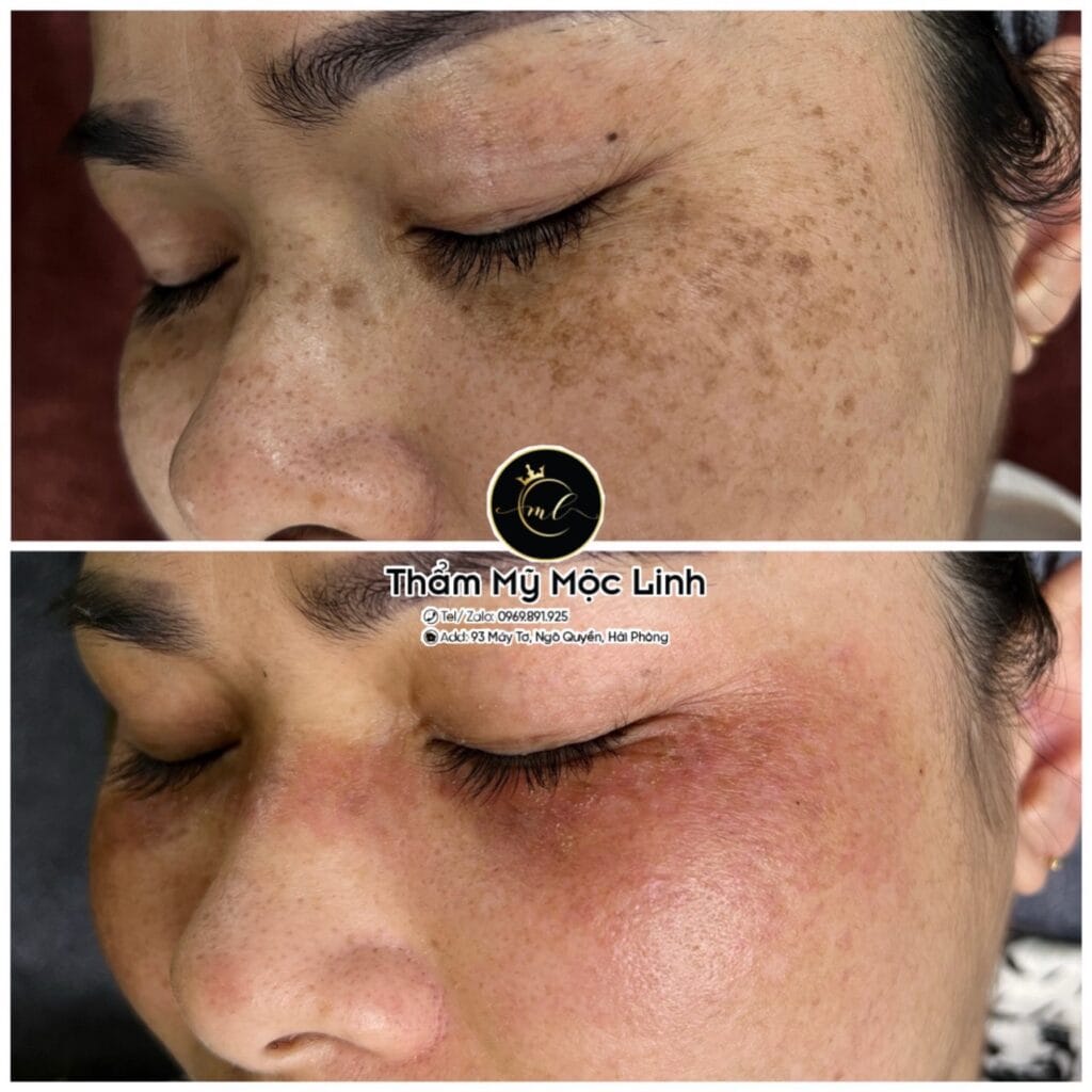 Điều trị tàn nhang