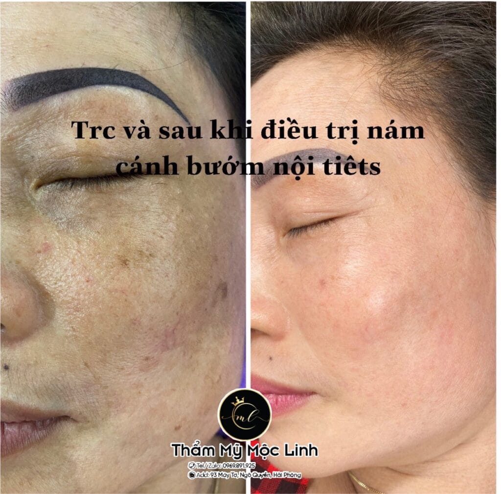 Điều trị tàn nhang