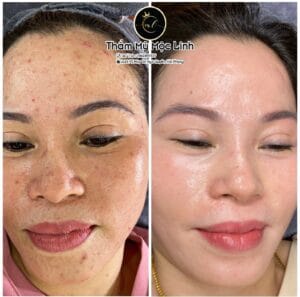 Điều trị tàn nhang