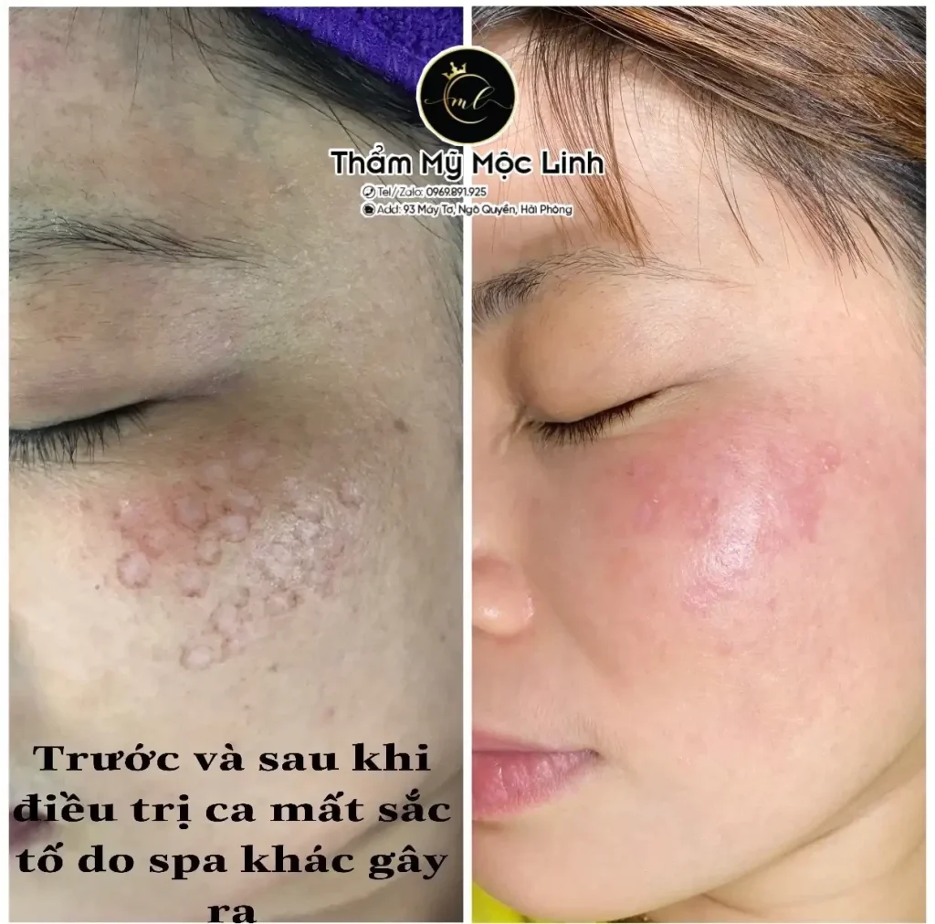 Trị nám/tàn nhang uy tín tại Hải Phòng