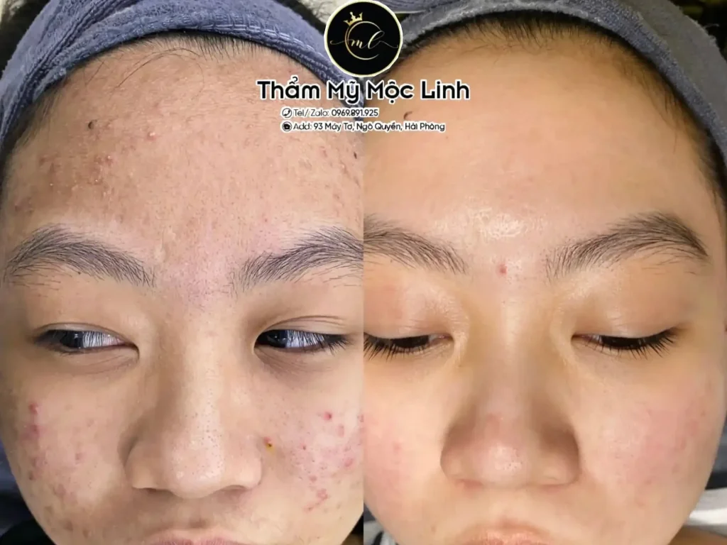 Trị Mụn Số 1 Hải Phòng