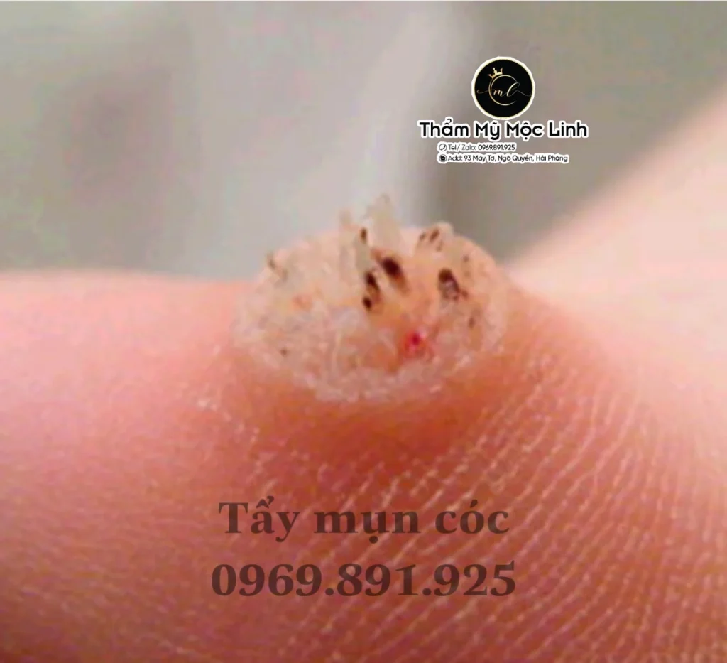 Tẩy nốt ruồi, mụn cơm, mụn thịt