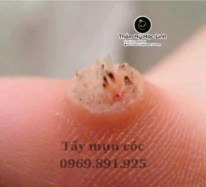 Tẩy nốt ruồi, mụn cơm, mụn thịt