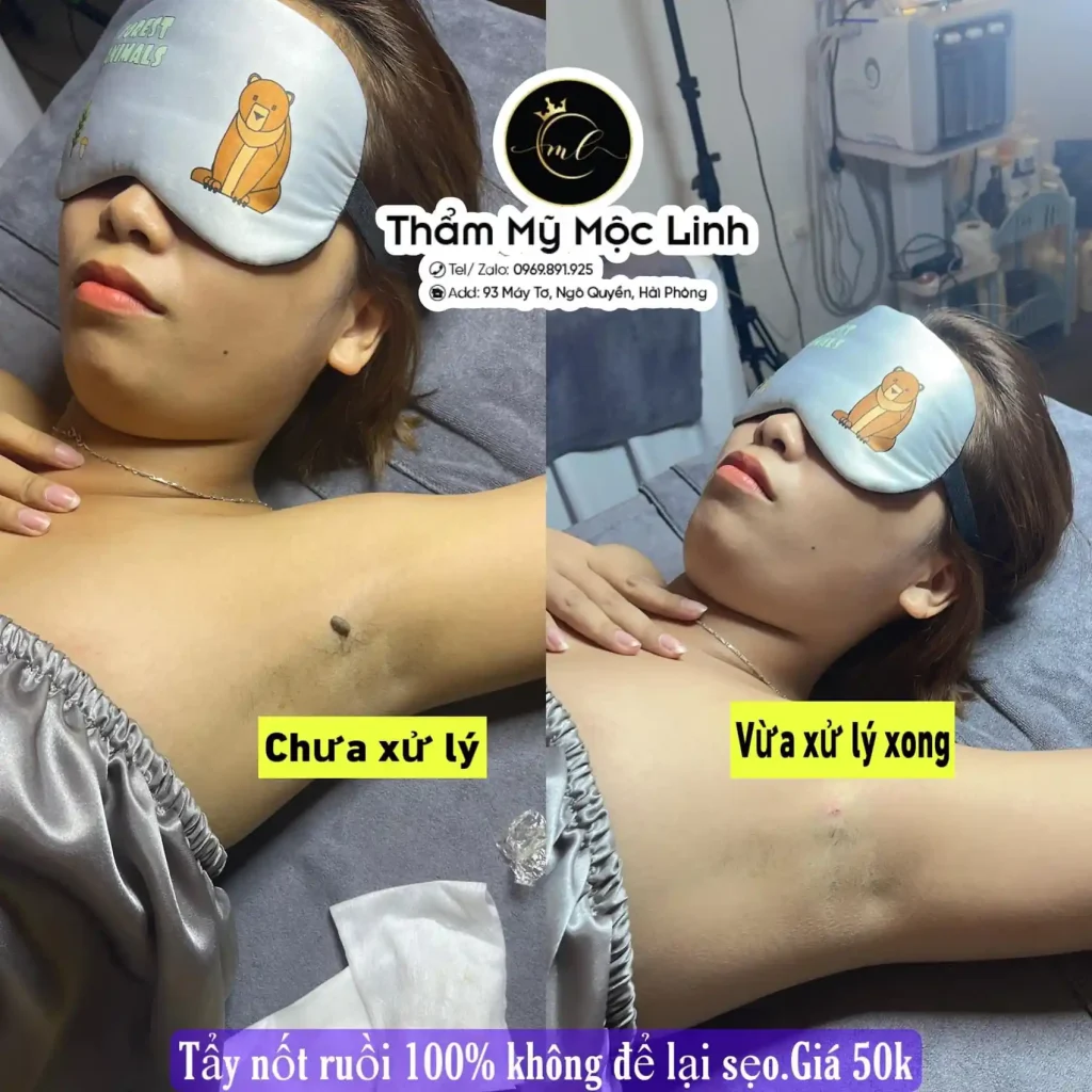 Tẩy nốt ruồi, mụn cơm, mụn thịt