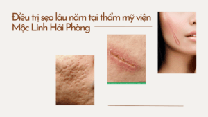 Điều trị sẹo lâu năm tại thẩm mỹ viện Mộc Linh Hải Phòng