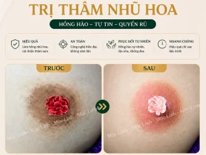 Làm hồng nhũ hoa – vùng kín tại Hải Phòng