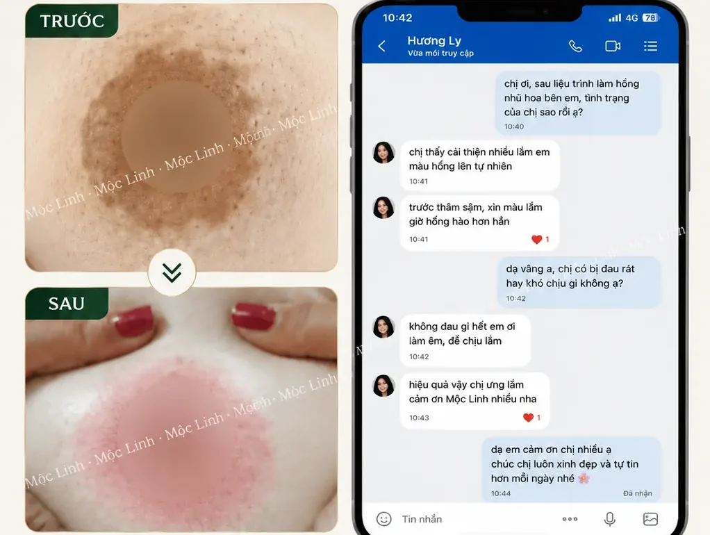 Làm hồng nhũ hoa – vùng kín tại Hải Phòng