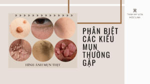 Phân biệt các kiểu mụn thường gặp