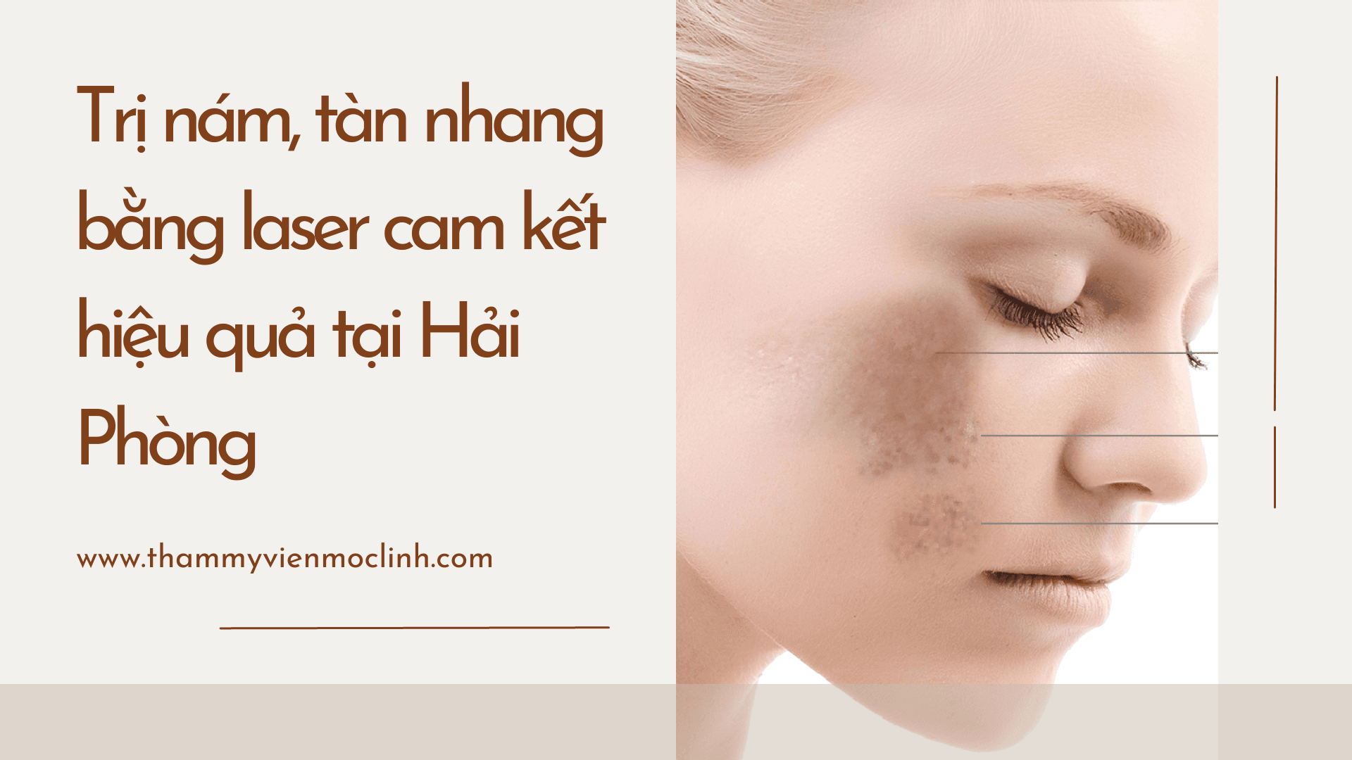 Điều trị nám da Hải Phòng an toàn tại Thẩm Mỹ Mộc Linh