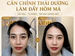 Tiêm Filler An Toàn Uy Tín Hải Phòng