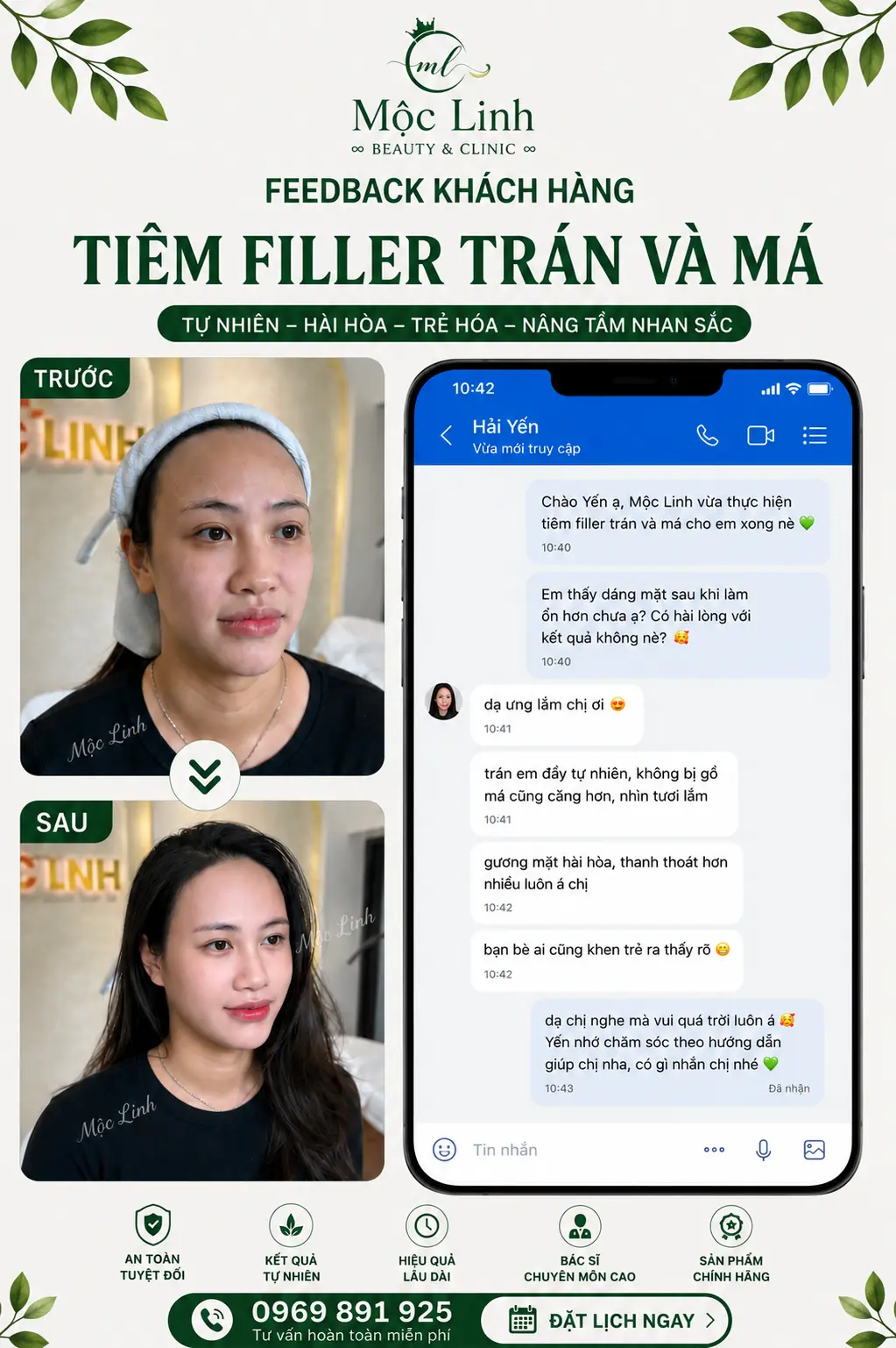 Kết quả tiêm filler tự nhiên hài hòa tại Hải Phòng
