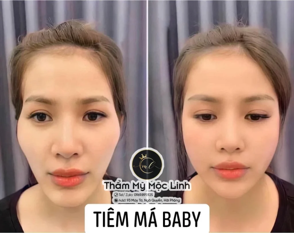 Tiêm Filler An Toàn Uy Tín Hải Phòng