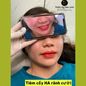 Tiêm Filler An Toàn Uy Tín Hải Phòng