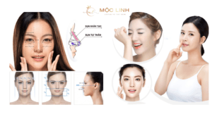 Nâng mũi cấu trúc 