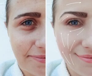 Những lưu ý sau khi tiêm Filler làm đầy rãnh cười