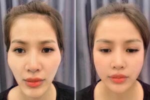  Tiêm Đầy rãnh cười