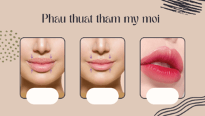phau thuat tham my moi tmvml