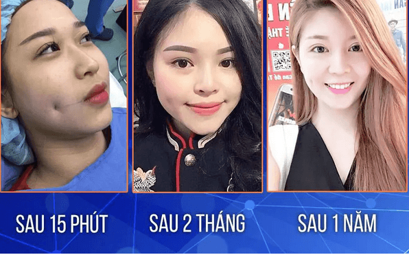 Tạo má núm đồng tiền