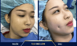 Tạo má núm đồng tiền