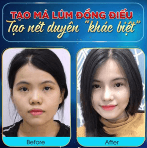 Tạo má núm đồng tiền