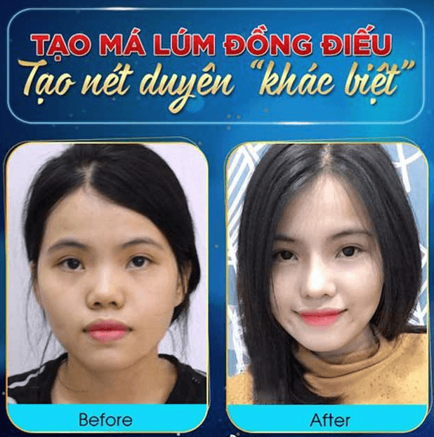 Tạo má núm đồng tiền