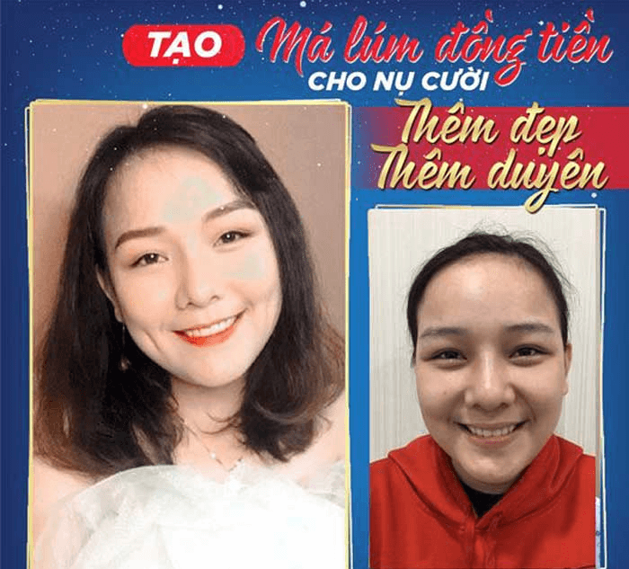 Tạo má núm đồng tiền