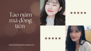 tạo má núm tmvmol