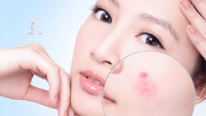 Điều trị mụn trứng cá