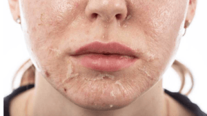peel mức độ trung bình