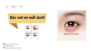 Bóc mỡ mí mắt dưới