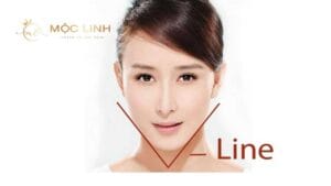 Độn cằm V-line