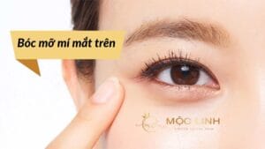 Lấy mỡ mí mắt trên