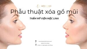Phẫu thuật xóa gồ mũi