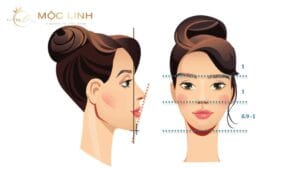 Sửa cằm vẹo, lỗi do phẫu thuật
