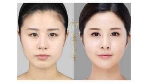 Tạo cằm tròn