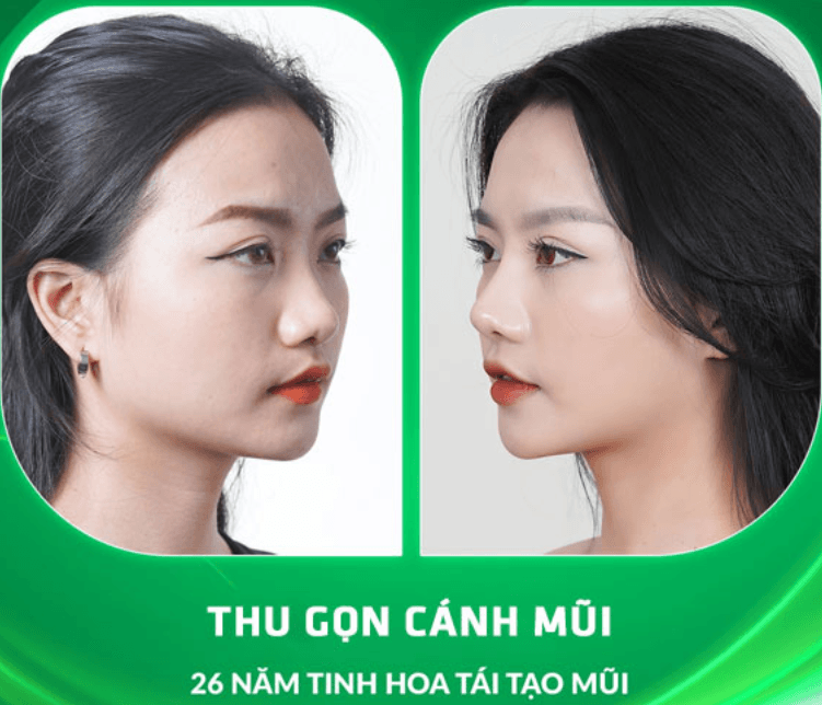 Thu nhỏ cánh mũi
