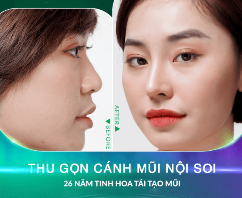 Thu nhỏ cánh mũi