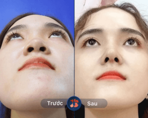 Thu nhỏ cánh mũi