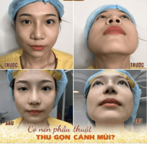 Thu nhỏ cánh mũi
