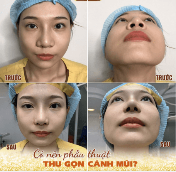 Thu nhỏ cánh mũi